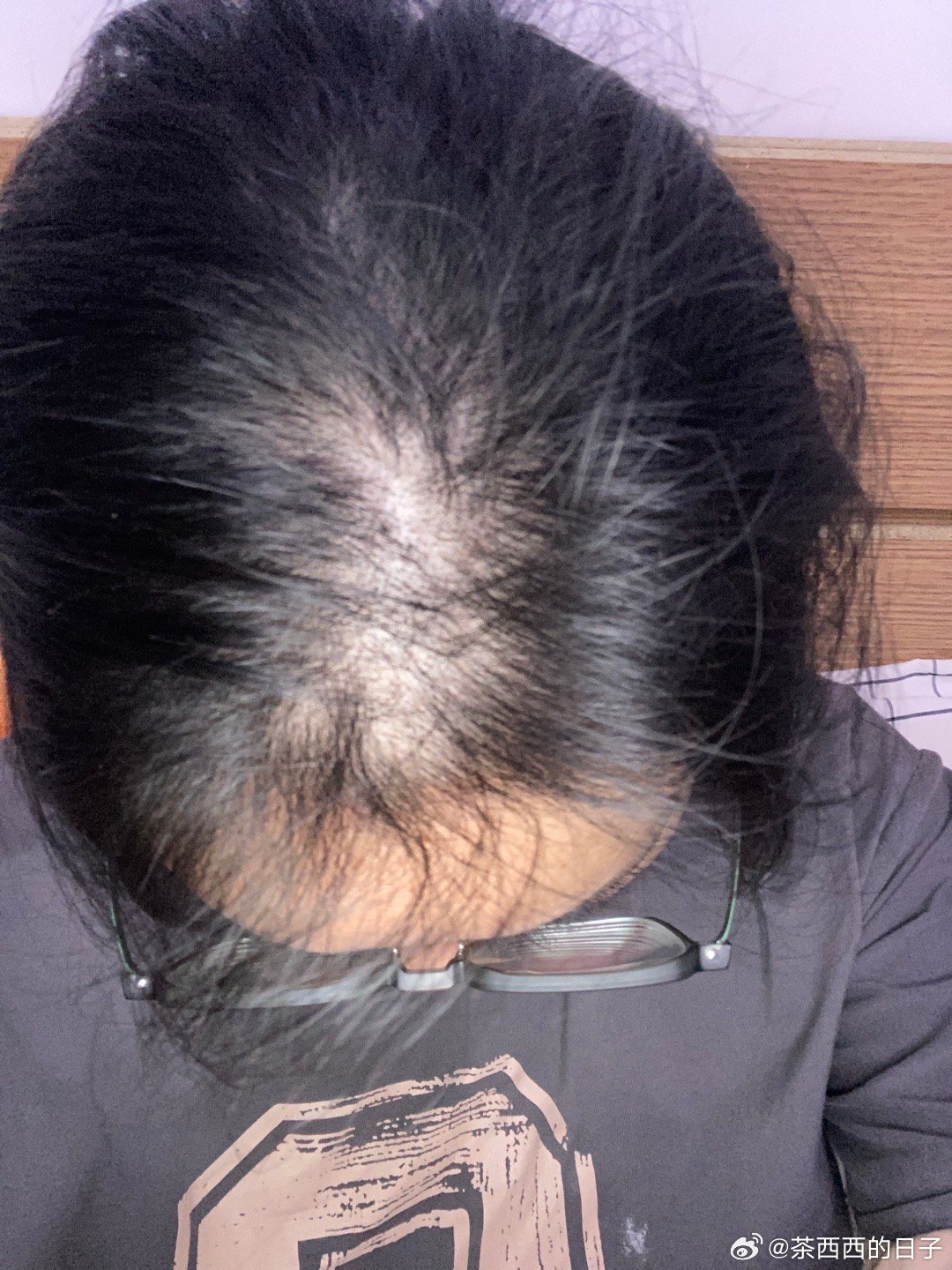 关于十六岁脱发是否会再生的探讨，十六岁脱发是否可再生，探讨青春期的脱发问题