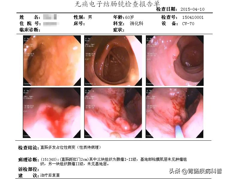 直肠癌四期患者活了十九年，生命的坚韧与奇迹，直肠癌四期患者十九年生命奇迹，生命的坚韧与闪耀